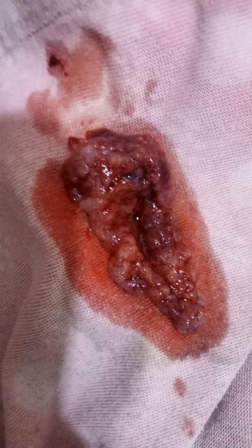 Saya sebelum USG baru ada 1 bulan setelah berapa hari kemudian hari Minggu kemarin keluar gumpalan