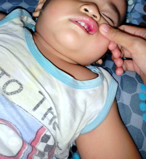 Bayi 17 bulan jatuh dan bibirnya  terbentur