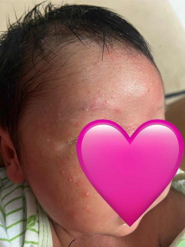 Adakah ini jerawat newborn ? Macam mana nak hilangkan