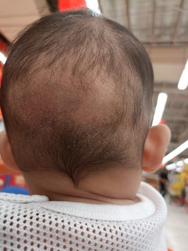 Salam, kenapa belakang kulit kepala anak mengelupas.. Ada cadangan krim yg sesuai ker?