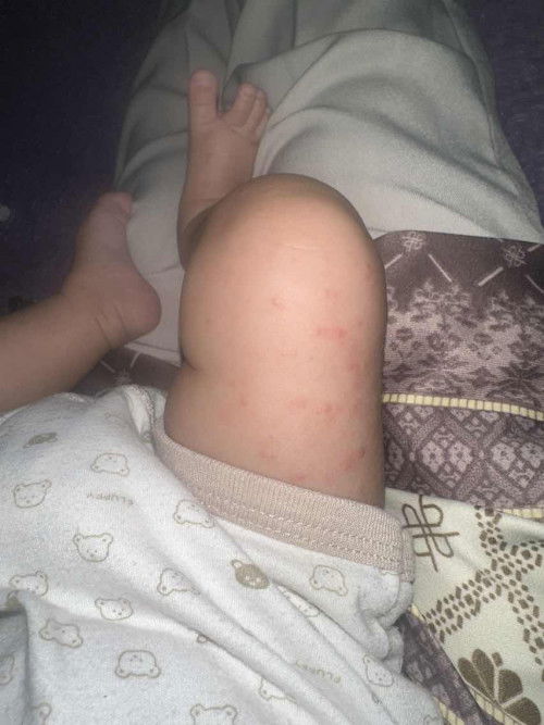 Bintik merah di bagian paha