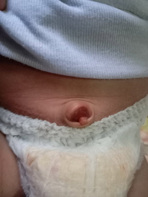 Granuloma tali pusar bayi