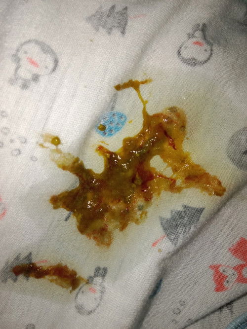 Bab bayi asi umur satu bulan ada bercak darahnya udah apakah wajar tanya ke bidan katanya kembung