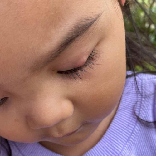 Fungi po  kaya or kagat ng insecto tong nasa mata ng toddler ko?