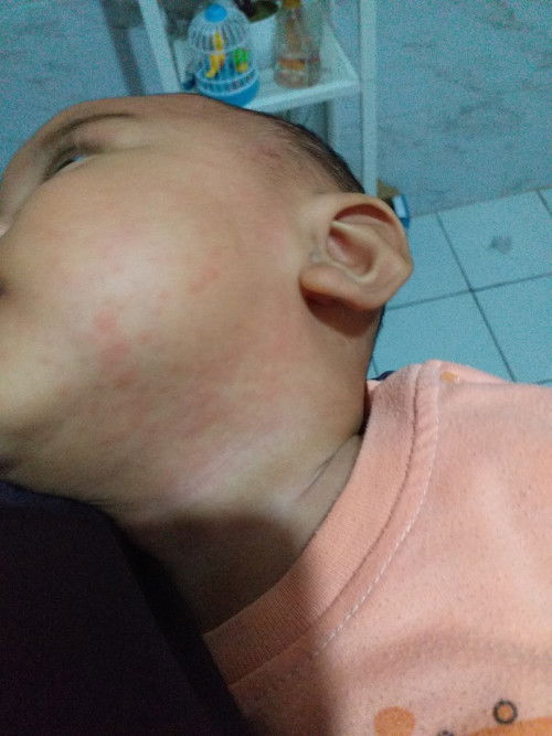 Bintik merah setelah demam