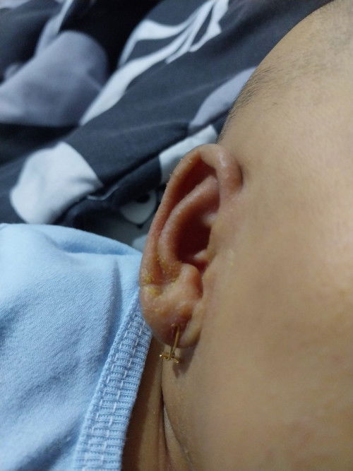 Kerak kuning di telinga