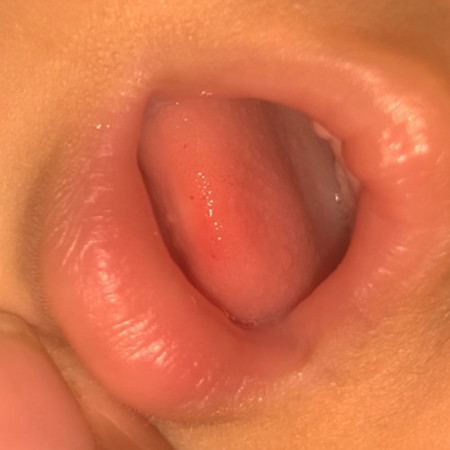 น้อง7เดือนมีตุ่มเล็กๆที่ลิ้น