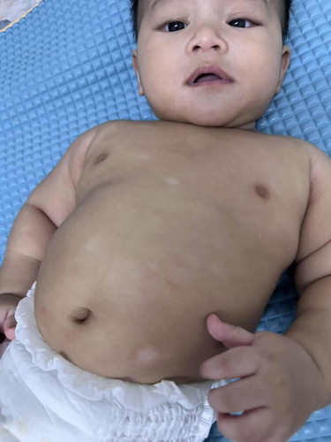 Berpanau atau Ringworm??