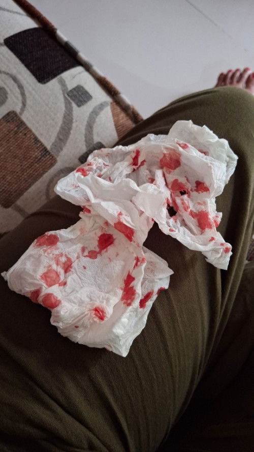 Mimisan hidung kanan