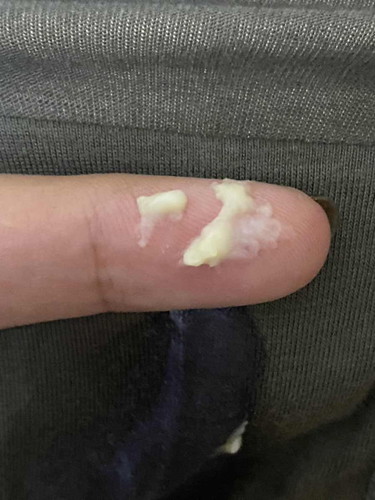 keputihan semasa preg