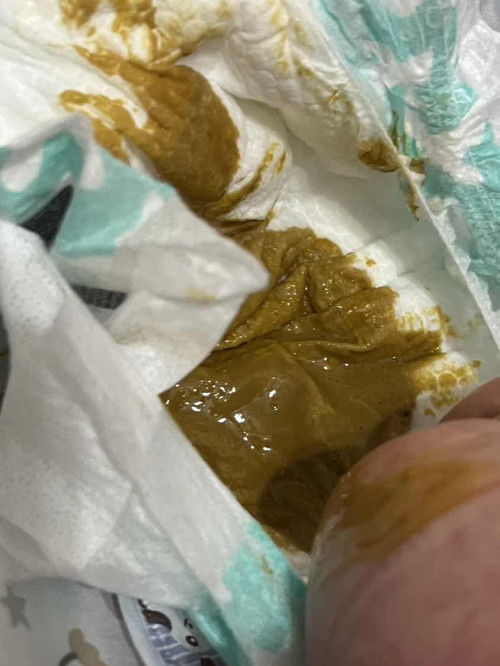 Watery poop but not frequent