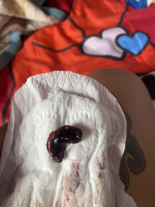 หลอดมา6วันแล้ว มีเลือดเป็นก้อนออกมาปกติไหมคะ