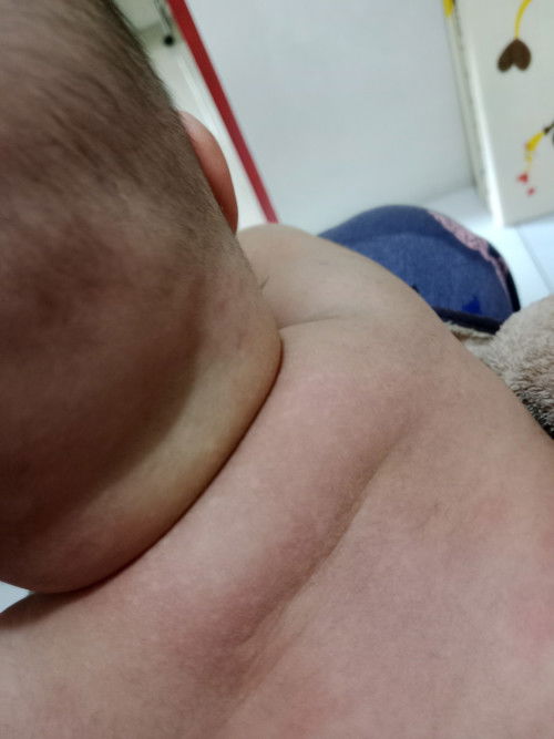 Bintik Putih2 bekas biang keringat bayi