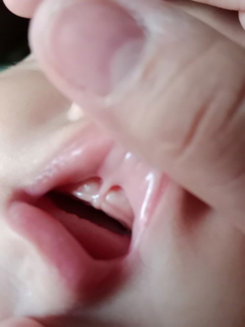 Lip Tie / Tongue Tie ( 3 months old )