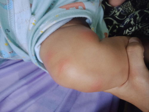 Yg ampuh buat bekas gigitan nyamuk pake apa ya Bun?