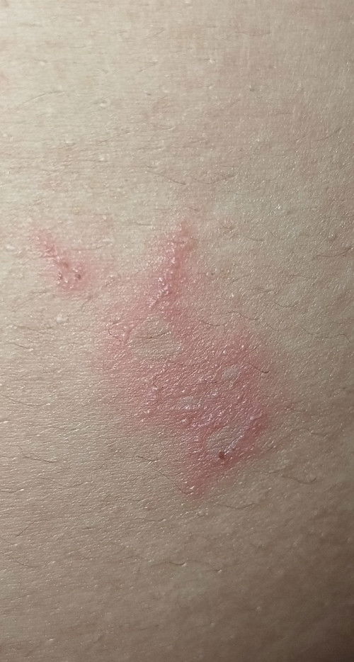 Muncul ruam di perut