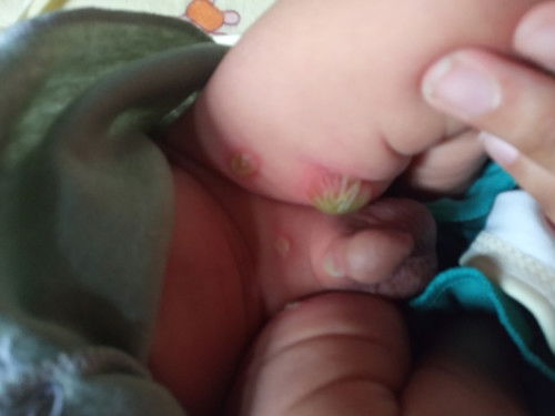 Bentol pada bayi 1 minggu