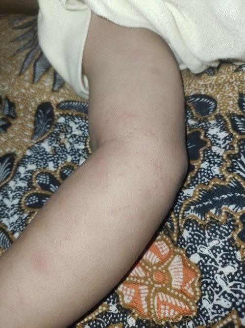 Bun mau tanya cara ngilangin ini gimana itu kek biyang keringat tapi ko gede2 yaa ? Ada yang sama ?