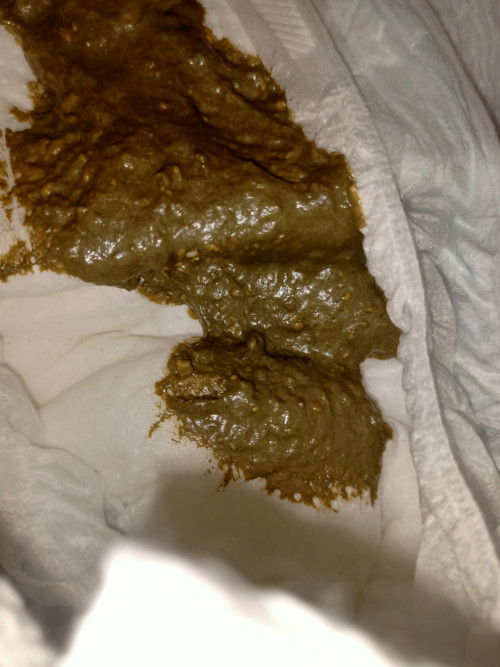 ช่วยดูให้หน่อยได้ไม่ค่ะว่าอึน้องปกติรึปล่าว