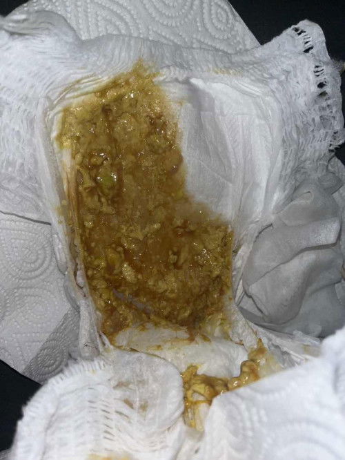 น้องทานนมผงค่ะ4เดือนครึ่ง สีแบบนี้ถ่ายผิดปกติไหมคะแม่ๆ