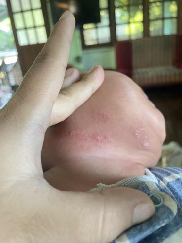 ใช่กลากน้ำนมไหมคะ