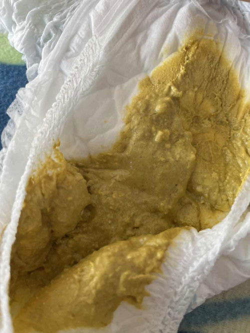 ทารกถ่ายเป็นฟองปกติไหมคะ