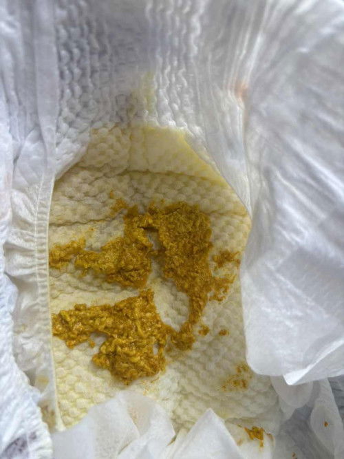 ลูกถ่ายแบบนี้ เบ่งอึจนร้องไห้ ปกติมั้ยคะ ขอบคุณล่วงหน้าสำหรับคำตอบค่ะ