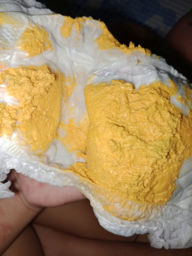 Apa kah normal bund pup bayi seperti ini, susu nya mix sufor dan asi