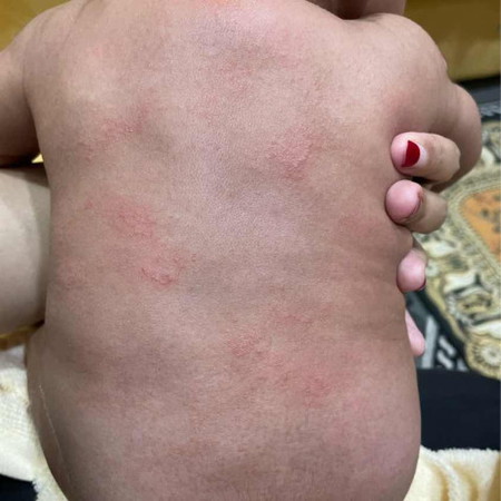 kulit kering
