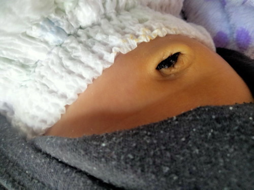 ลูกอายุ13วันสะดือเป็นแบบนี้