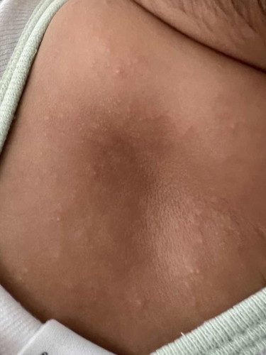 Tiny bumps