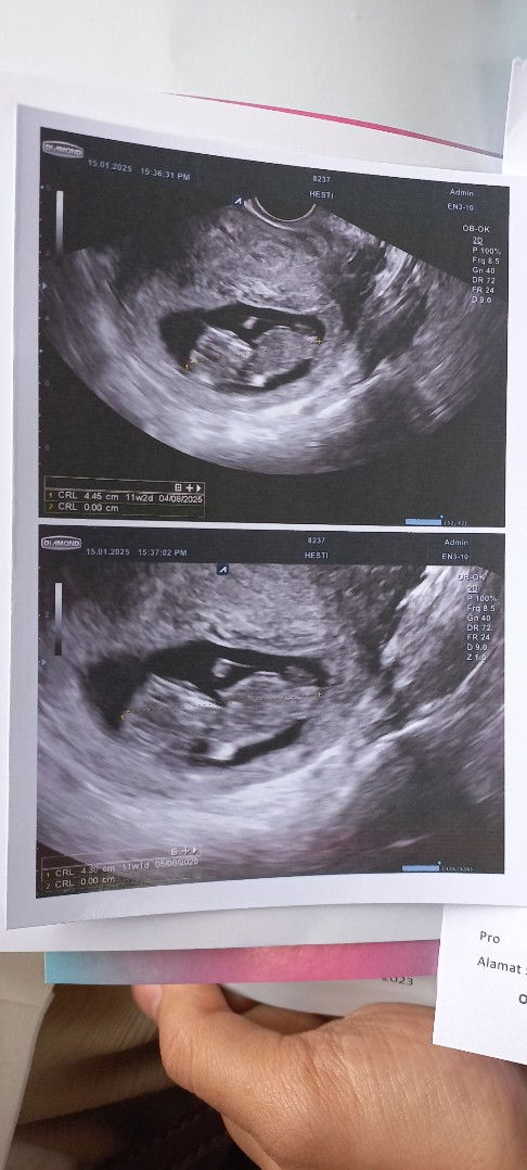 Tentang usia kehamilan