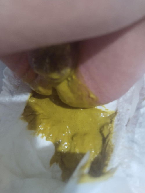 Newborn poop