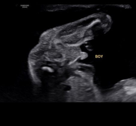 23 weeks gender reveal