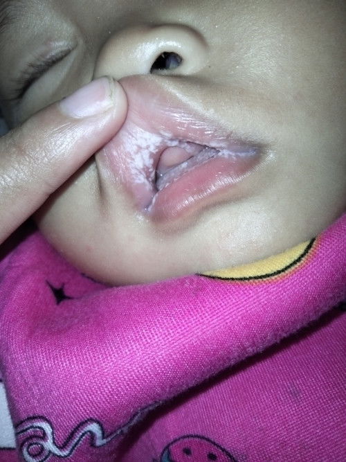 Mulut bayi putih putih