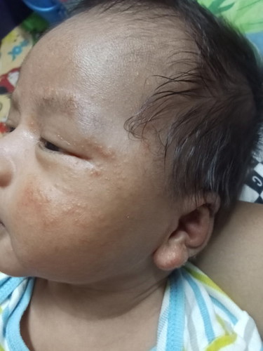 ลูก1เดือนผื่นขึ้น