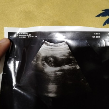 Prtma USG usia 5weeks
Udh ada kantong nya
Cmn dktr GK blg ada janin nya apa tidak apa yg hrs dilakui