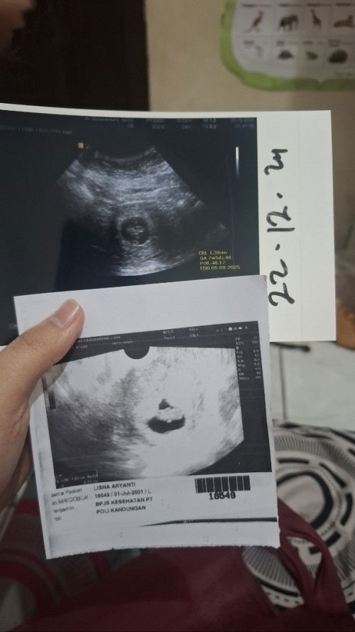 Gimana rasanya di kuret?