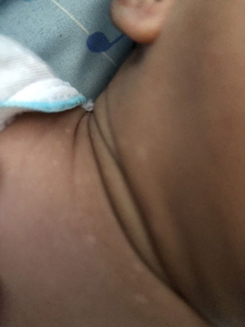 Bintik putih pd bayi NB