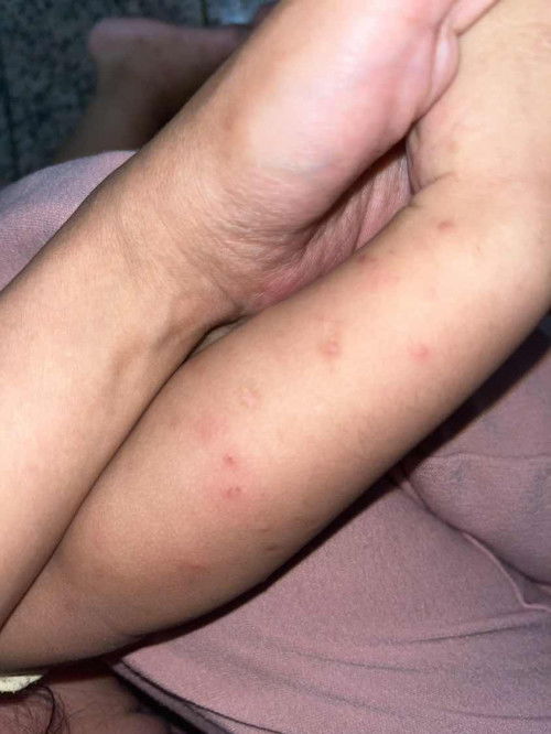 Ruam gatal beberbekas seperti koreng  pada anak