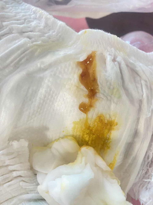 ขอปรึกษาแม่ๆกันหน่อยค่ะ กังวลมาก😭😭