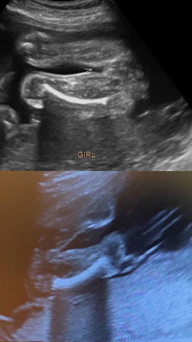 gender baby