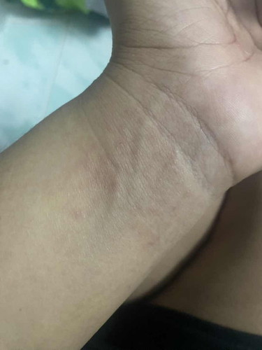ผื่นคันขึ้นตามซอกนิ้วมือนิ้วเท้า