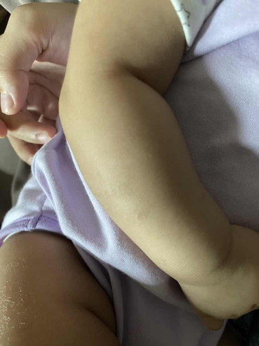 Kulit Baby Mengelupas
