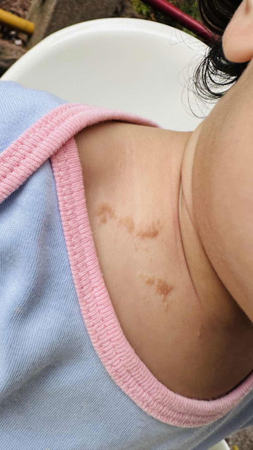 Cara hilangkan kesan ruam yang dh tinggalkan kesan