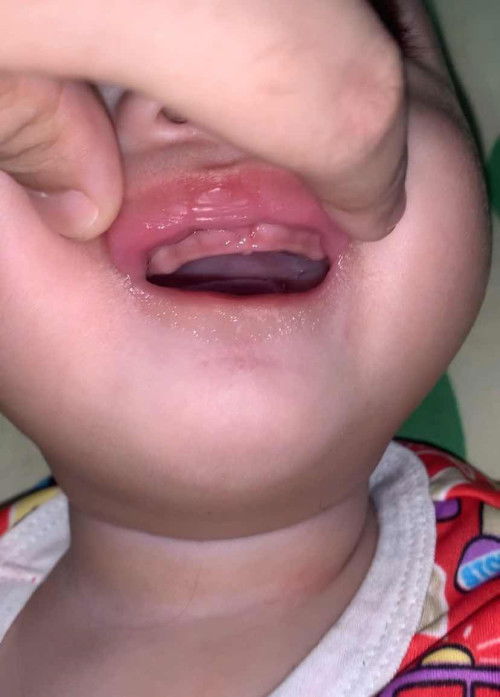 แบบนี้คือฟันจะขึ้นไหมคะ