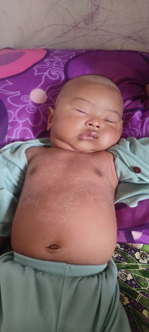 Kulit perut bayi 2 bulan mengelupas