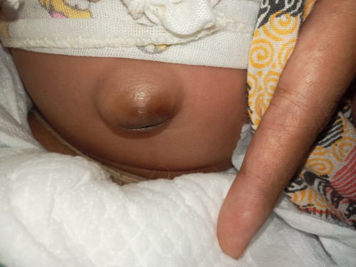 Urgent.. puser bayi bodong