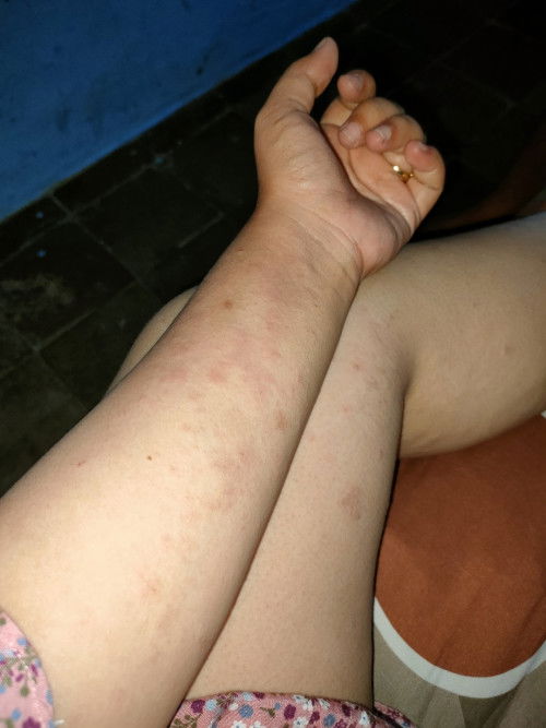 Hamil tm3 gatal gatal seluruh badan