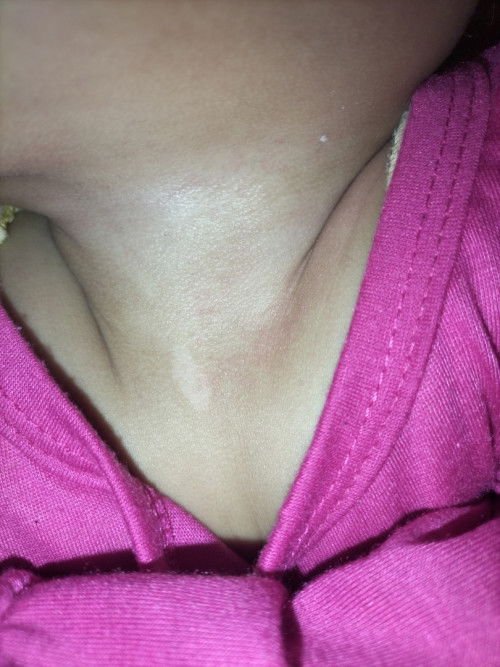 Cara menghilangkan putih2 di dada bayi